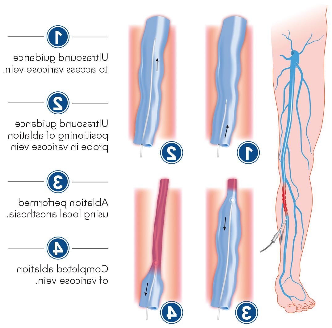 varicose vein treatment